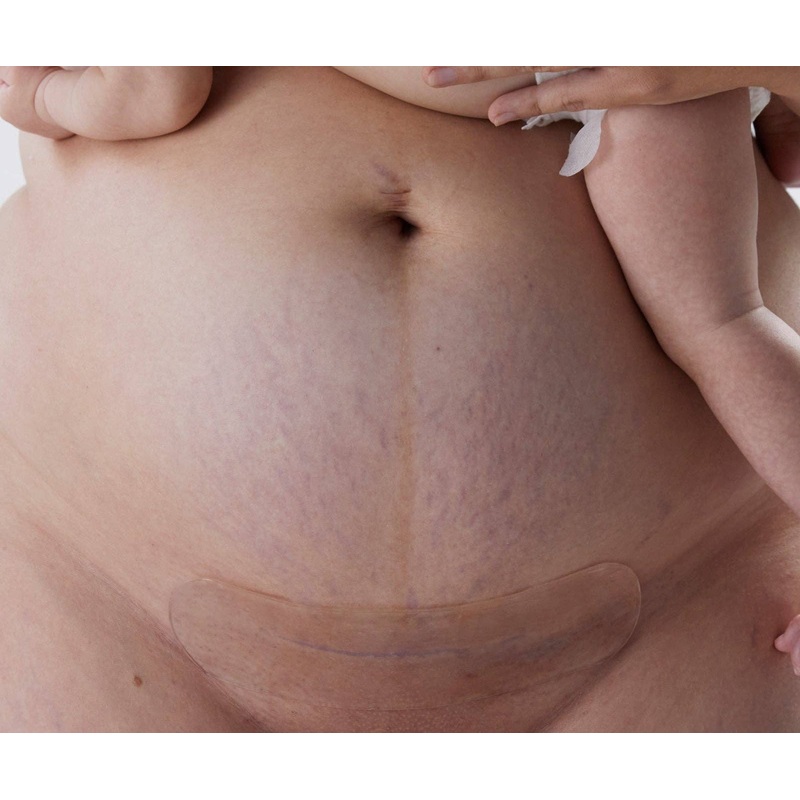 Bare Mum - Silicone Gel Scar Strips 3 STRIPS